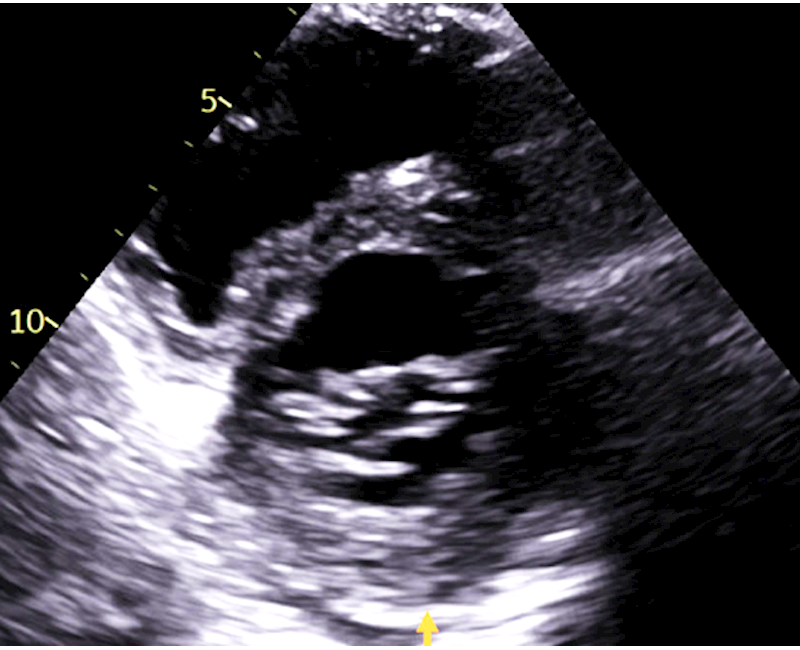 Acute myocardial infarction mimicking hypertrophic cardiomyopathy